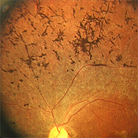 Генетическая ДНК диагностика пигментного ретинита (тапеторетинальной абиотрофии)